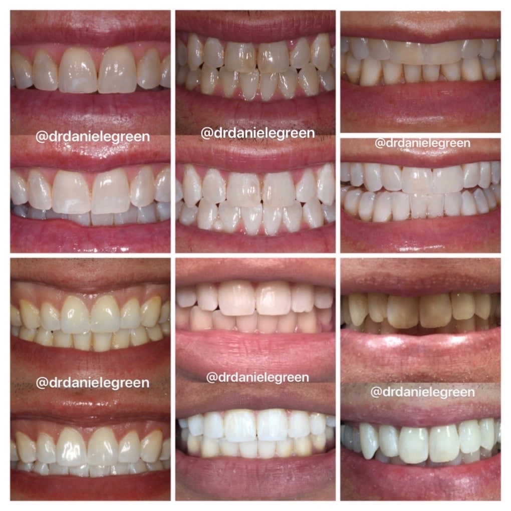 Photos of before and after smiles showing brighter smiles after in-office teeth whitening.