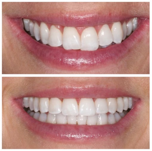 Invisalign Before and After Photo.