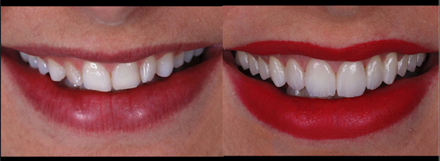 Dental Veneers: A Quick Path to a Perfect Smile