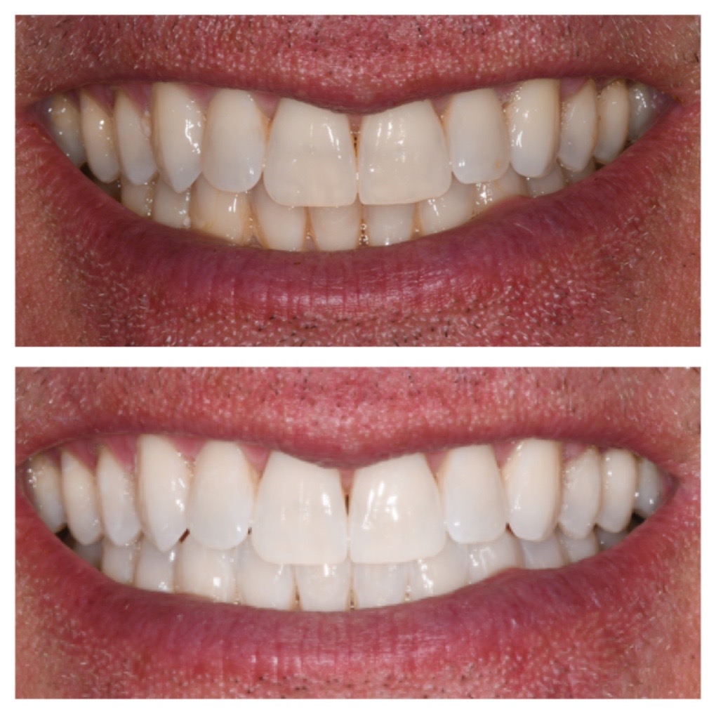 Philips Zoom Whitening before-and-after results in a single stacked image
