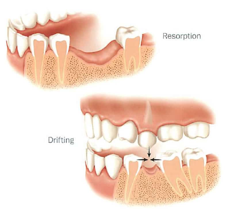 Coastal Smiles Newport Beach | Orange County California - Bone Graft